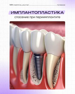 Имплантопластика: эффективное удаление биоплёнки.